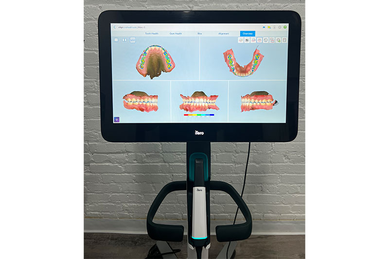 Itero Lumina Intraoral Scanner in Asheville