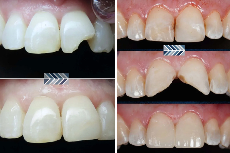 Emergency Dentistry in Asheville