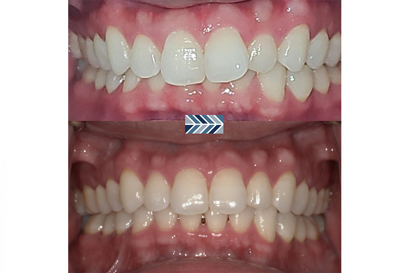 Invisalign in Asheville