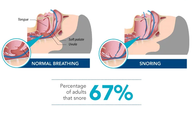 Solea Sleep for Snoring in Asheville