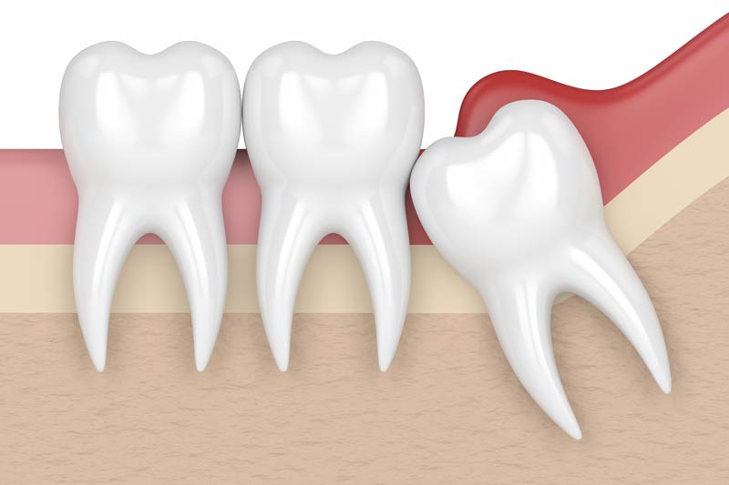 Custom Mouthguards in Asheville at Embark Dental